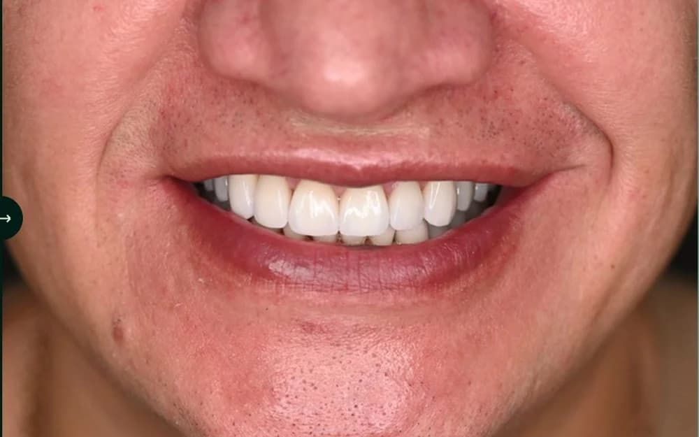 A Batteesee patient's finished result